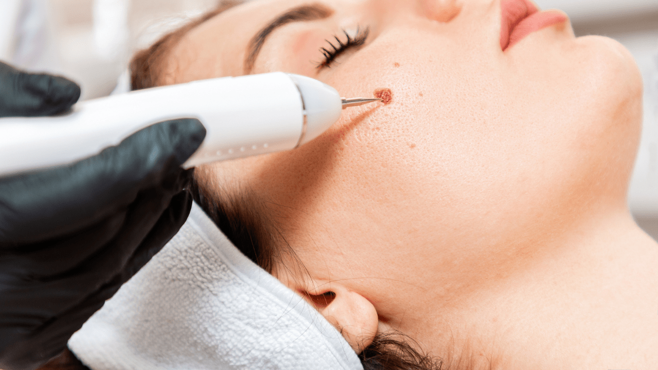 a girl getting a mole removed on her face